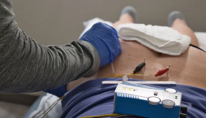 How Does Physical Therapy Dry Needling With Electrical Stimulation Improve  Symptoms? - Mend Colorado