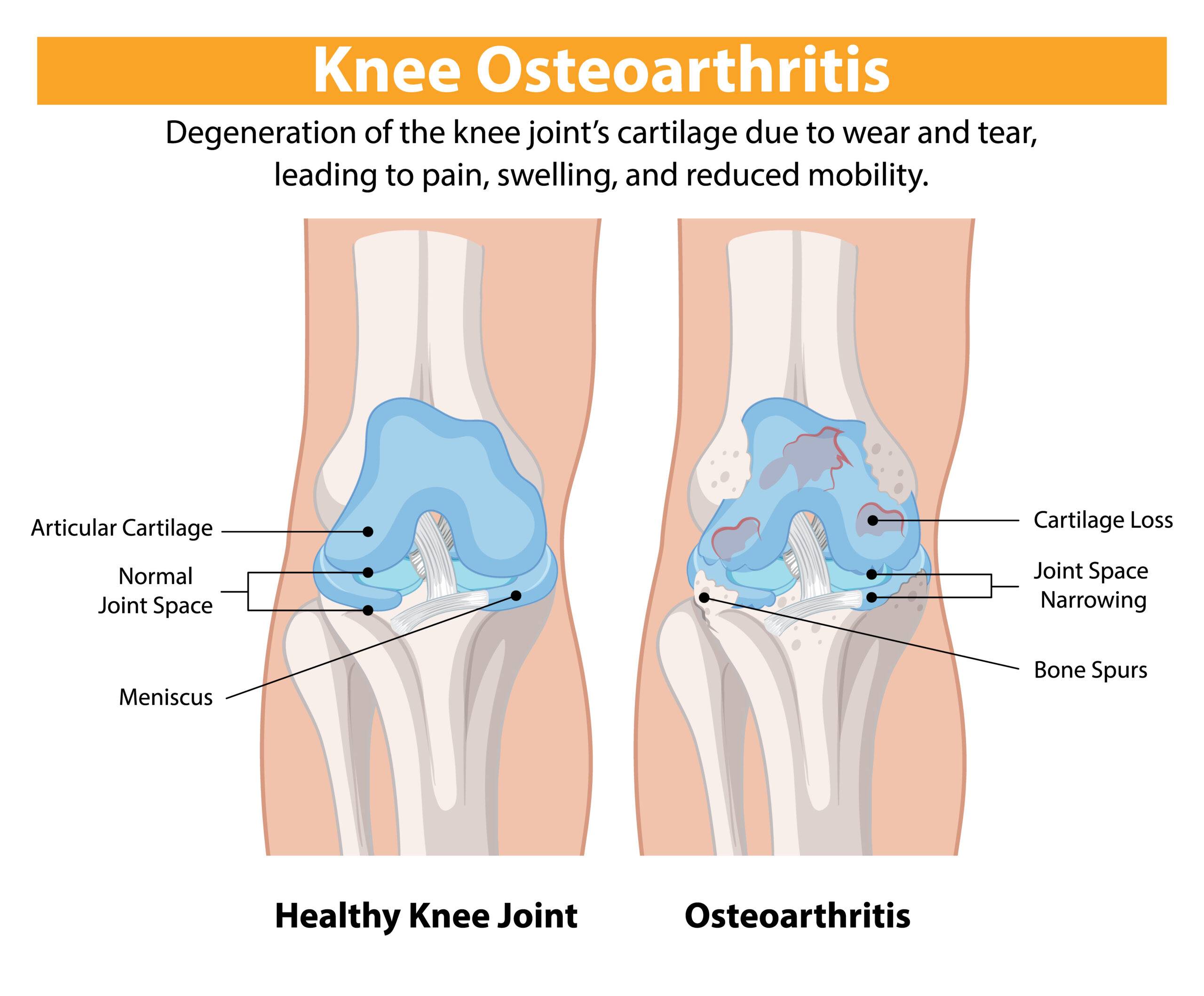 Knee Osteoarthritis Comparison
